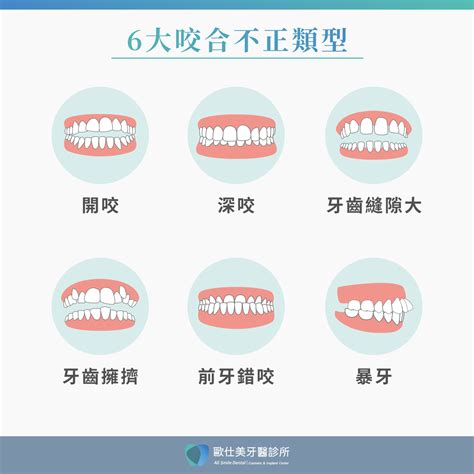 上下排牙齒平行|咬合不正要治療嗎？認識咬合不正類型、成因、治療方式